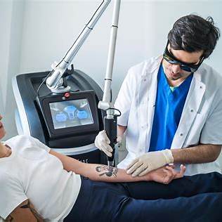 détatouage laser à Villefranche