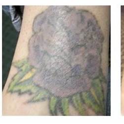 détatouage laser à Villefranche