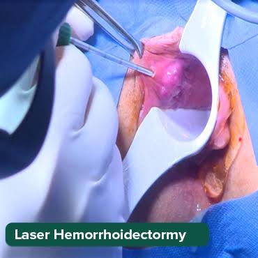 Hémorroïdes laser